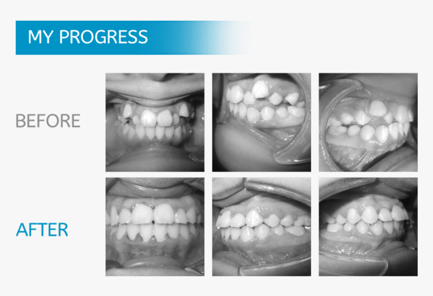 Chicago Orthodontics Braces - Teeth Xray Before And After Braces, HD Png Download, Free Download