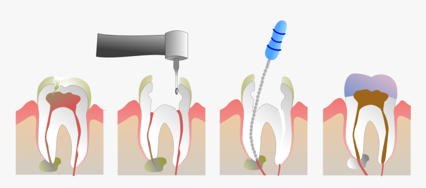 Root Canal Treatment In Colombia, HD Png Download, Free Download
