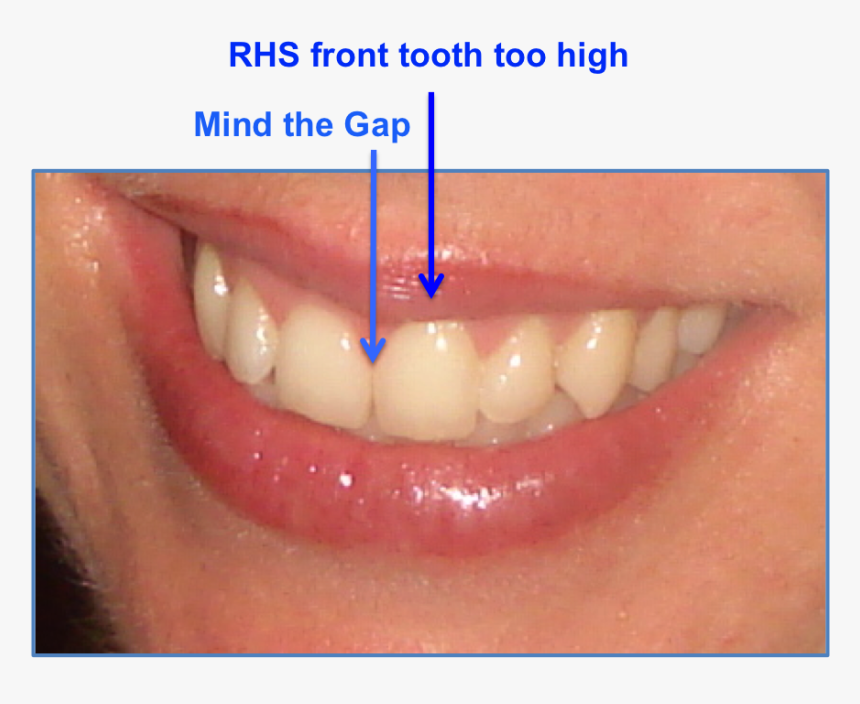 Invisalign Growingonup How To Make Your Teeth Whiter - My Teeth Transparent, HD Png Download, Free Download